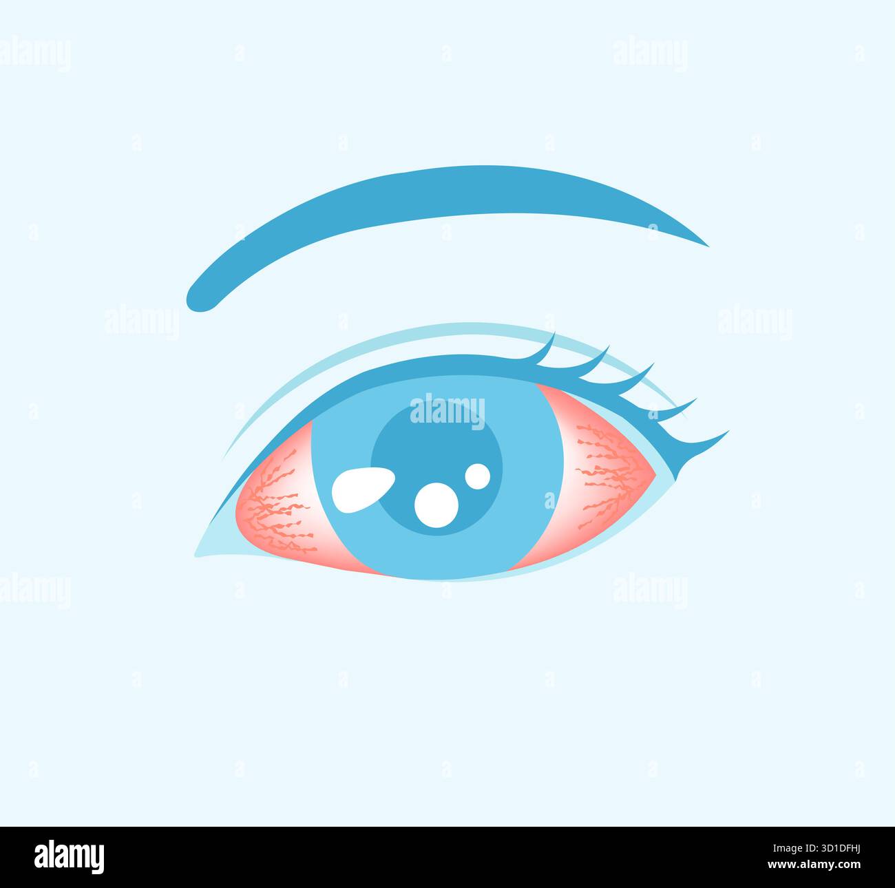 Bindehautentzündung (rosa Auge) Vektorgrafik Stock Vektor