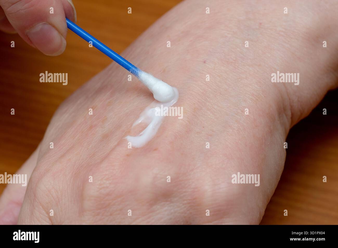 Eine Hand trägt beruhigende Creme mit einem Wattestäbchen auf, um die Haut weich zu pflegen. Stockfoto