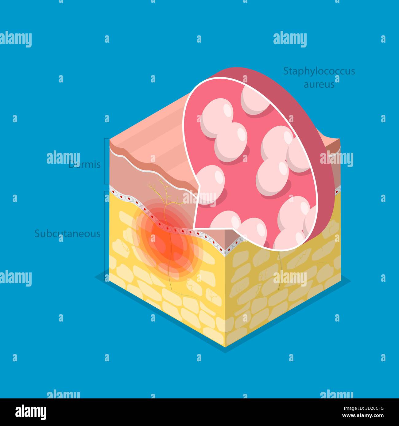 3D Isometrische flache Illustration der Cellulitis, bakterielle Infektion 3D Isometrische flache Illustration der Cellulitis, bakterielle INFE Stockfoto