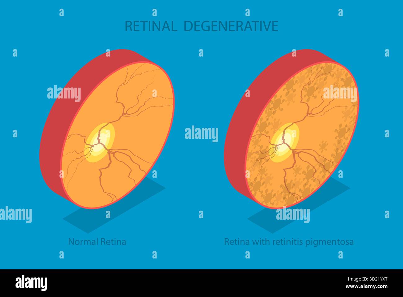 3D Isometrische flache Darstellung von Netzhautdegenerativen , Sehstörungen, Blind Spots Stockfoto