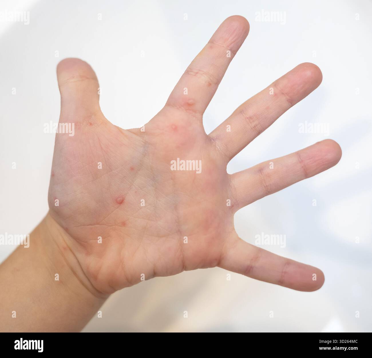 Die offene Handfläche des Kindes zeigt charakteristische rote Blasen und kleine Beulen, Symptome einer Virusinfektion wie Hand-, Maul- und Klauenseuche, auf einem hellen Hintergrund Stockfoto