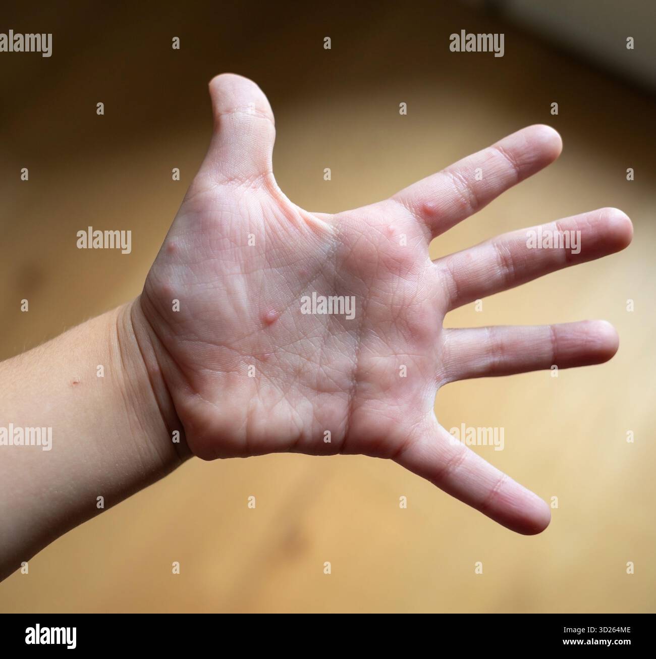 Kinderhand zeigt Hand-, Maul- und Klauenerkrankungen Ausschlag mit mehreren kleinen rötlichen Beulen und Blasen auf der Handfläche, pädiatrisches dermatologisches Symptom einer Virusinfektion Stockfoto