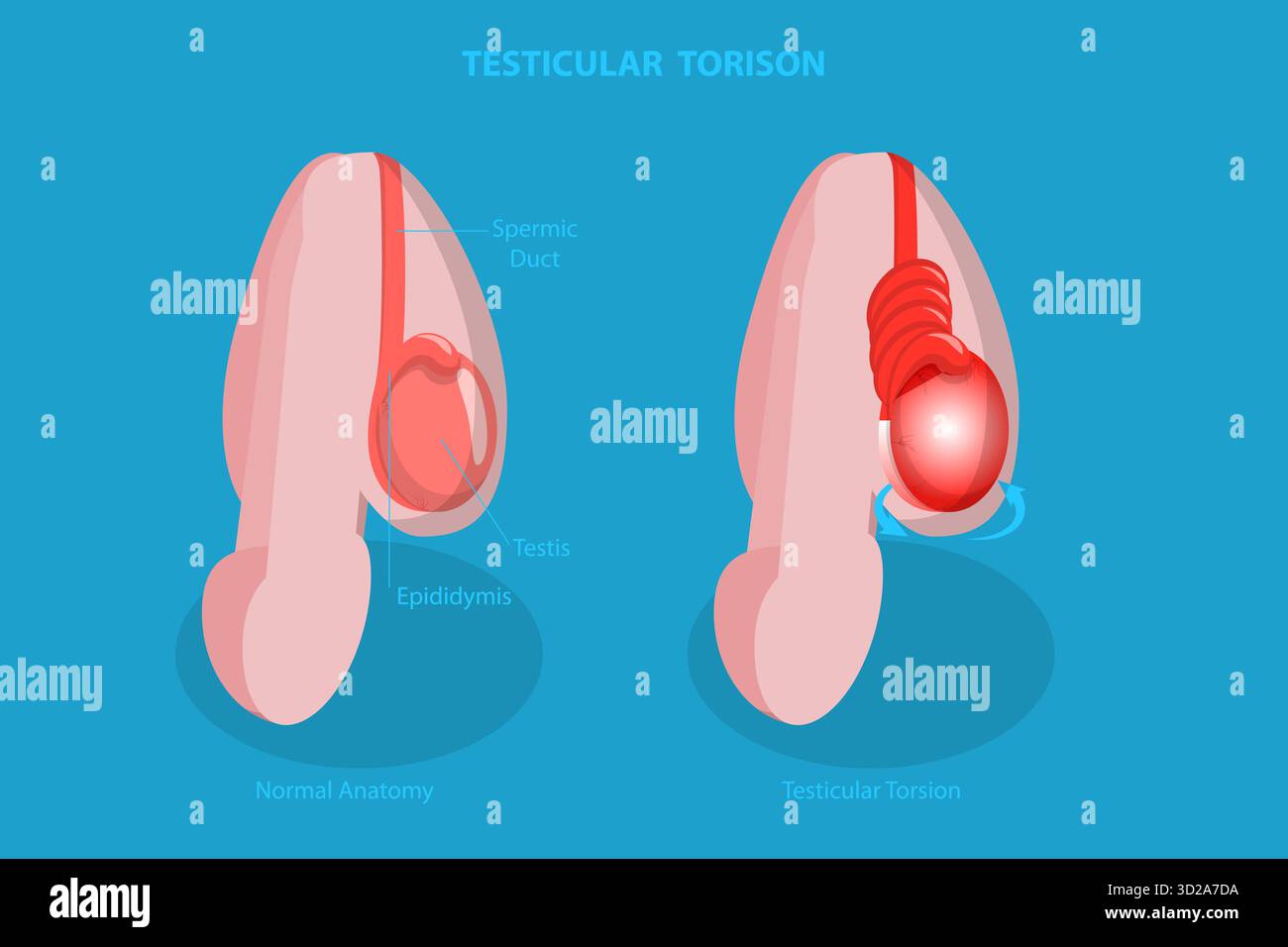 3D Isometrische flache konzeptionelle Illustration von Hodentorison, Störung des männlichen Reproduktionssystems 3D Isometrische flache konzeptionelle Illustration von Hodentorison, Störung des männlichen Reproduktionssystems Stockfoto