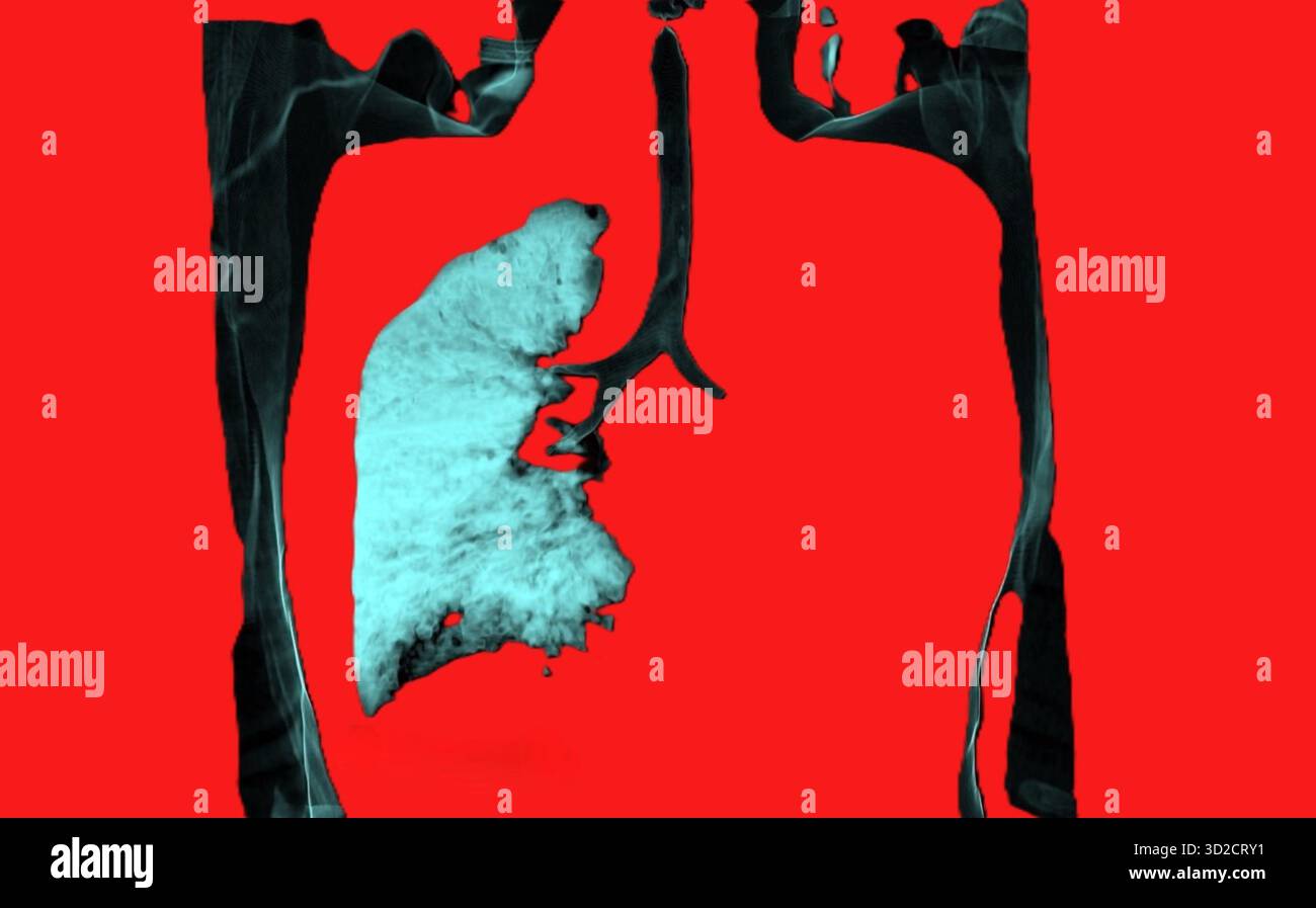 Farbige Computertomographie (CT) eines Patienten mit linker Lunge ohne Luft aufgrund eines Karzinoms. Stockfoto