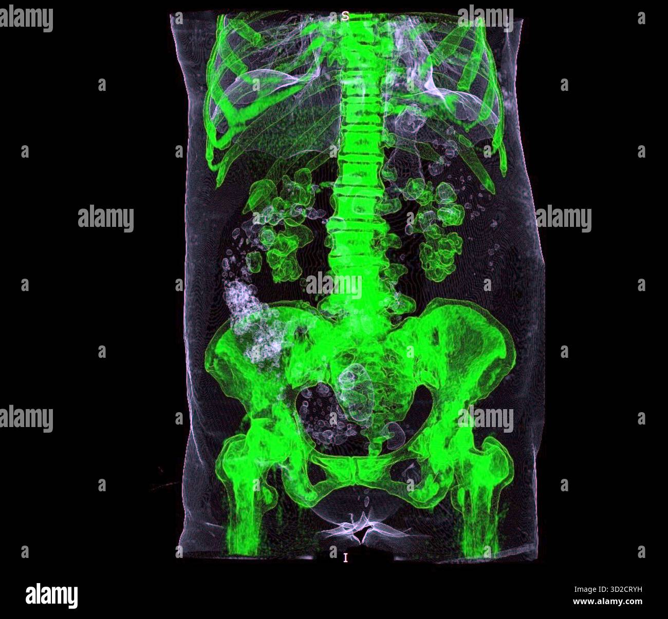 Farbige 3D-Computertomographie (CT) eines Patienten mit beidseitigen Nierensteinen (weiß). Stockfoto