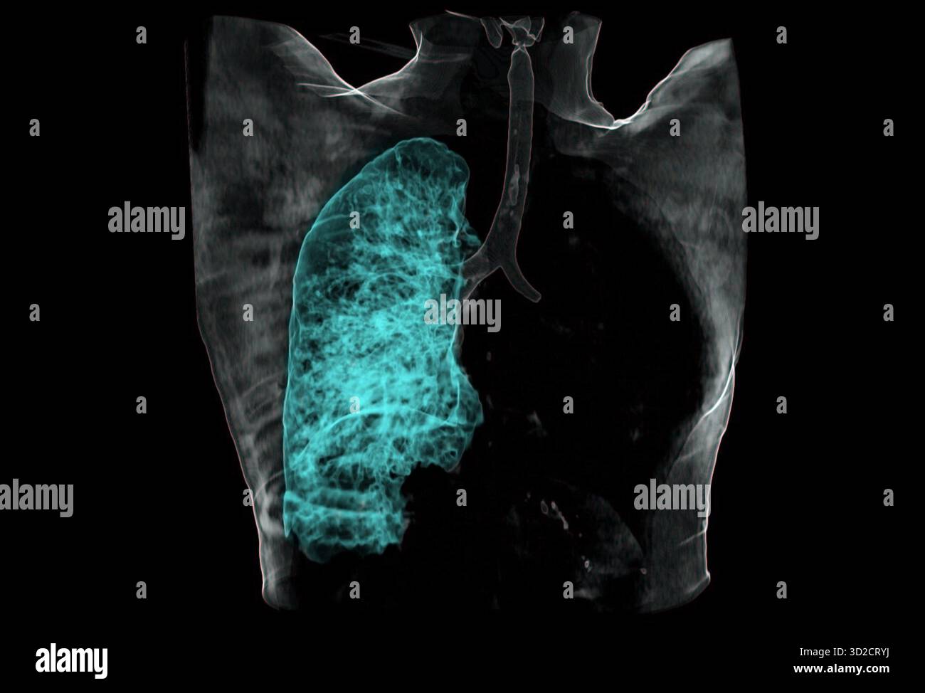 Farbige 3D-Computertomographie (CT) eines Patienten mit linker Lunge ohne Luft aufgrund eines Karzinoms. Stockfoto