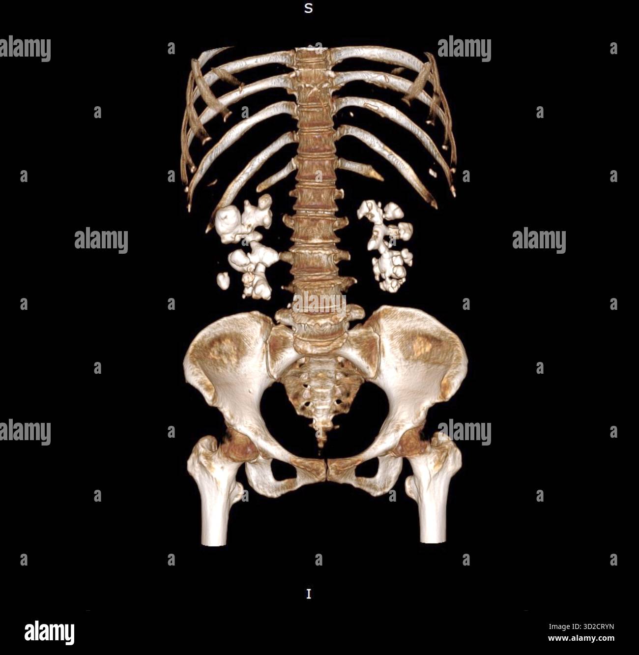 Farbige 3D-Computertomographie (CT) eines Patienten mit beidseitigen Nierensteinen (weiß). Stockfoto