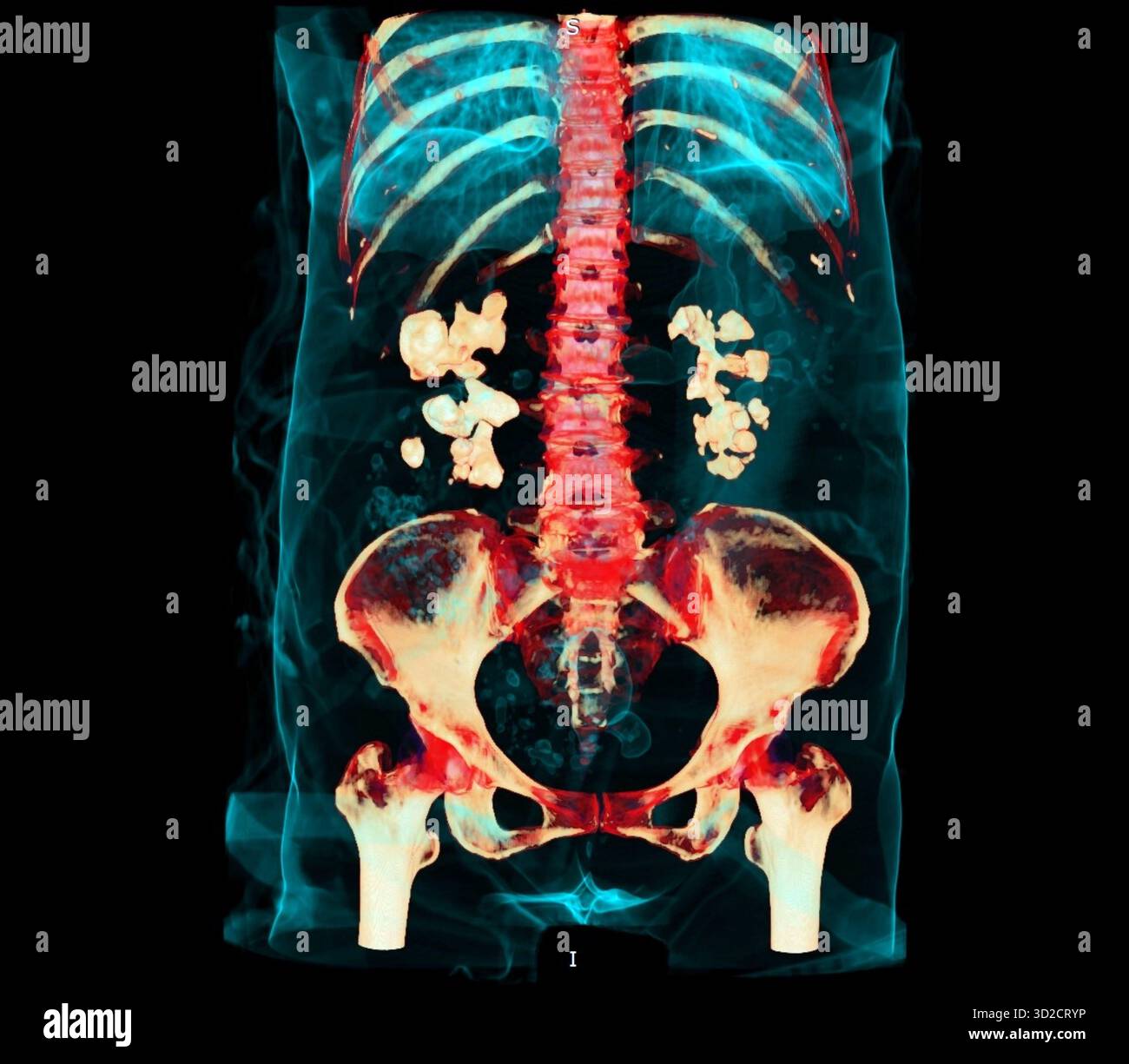 Farbige 3D-Computertomographie (CT) eines Patienten mit beidseitigen Nierensteinen (weiß). Stockfoto