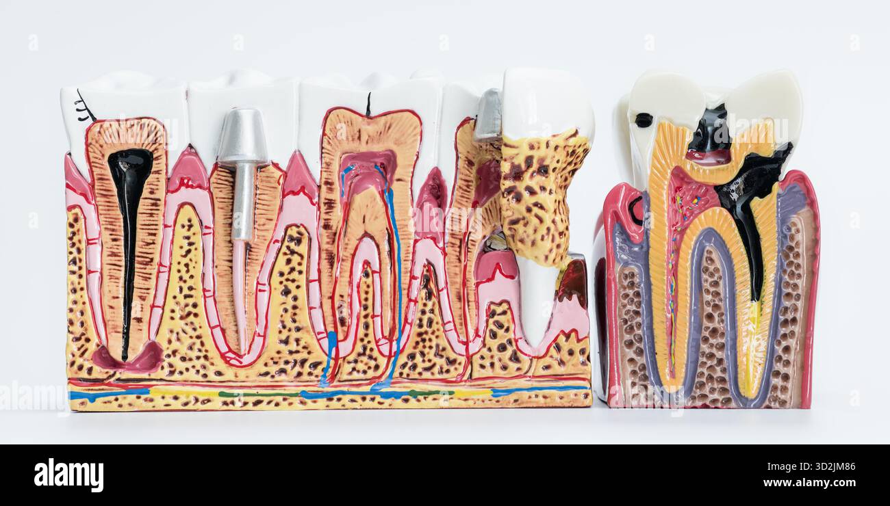 Nebeneinander angeordnete Zahnmodelle mit schweren Karies, Implantaten, Zahnfleischerkrankungen und anatomischen Strukturen für die Zahnerziehung. Stockfoto
