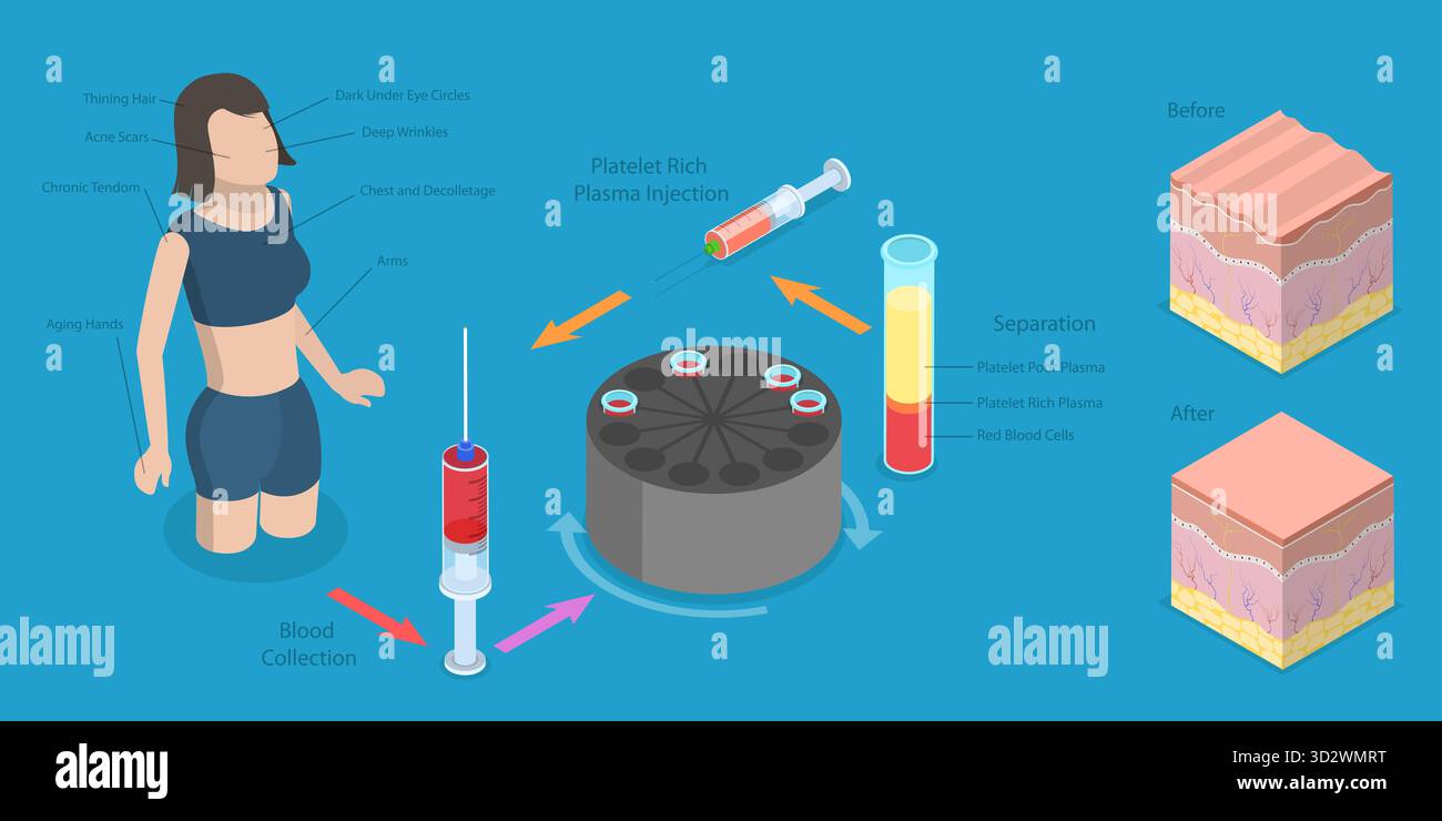 3D Isometrische flache konzeptionelle Illustration von PRP-Verfahren, Frauen Schönheit und Hautpflege 3D Isometrische flache konzeptionelle Illustration von PRP-Verfahren, Frauen Schönheit und Hautpflege Stockfoto