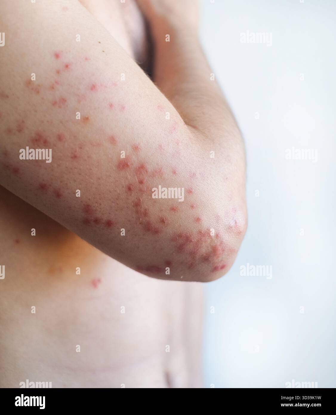 Weit verbreitete rote juckende Flecken auf einer bemannten Haut mit Trockenheit und Schuppung, die ein Aufflammen des chronischen Ekzems im Video zeigen. Stockfoto