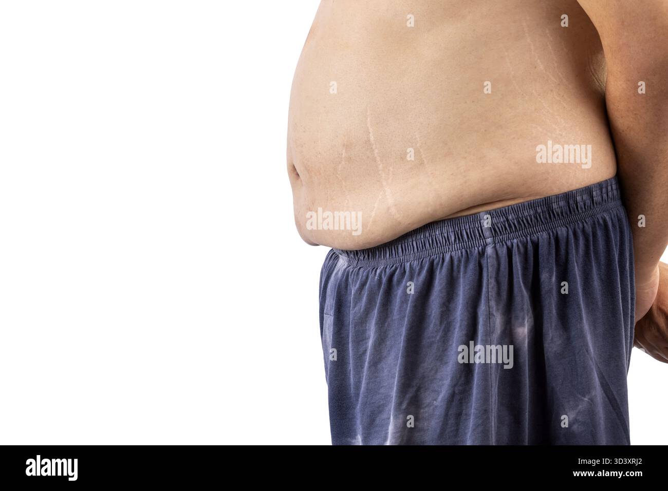 Ein Mann mit sichtbarem Bauchfett und Dehnungsstreifen steht seitlich und trägt lose blaue Shorts vor weißem Hintergrund Stockfoto