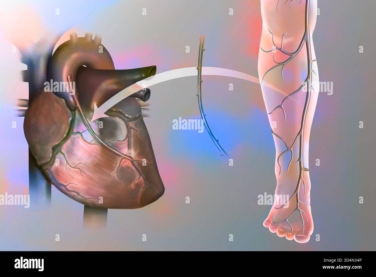 Koronararterien-Bypass-Transplantation. Die Obstruktion eines Koronargefäßes durch eine atheromatöse Plaque wird durch die Platzierung eines Bypass kompensiert. Stockfoto