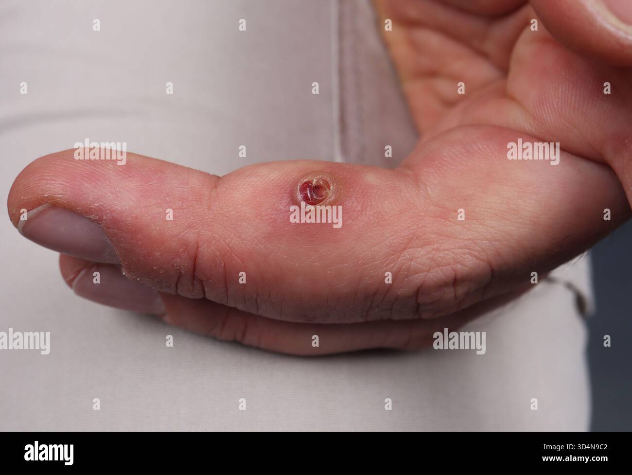 Botriomykom des Mittelfingers bei einem 26-jährigen Mann. Stockfoto