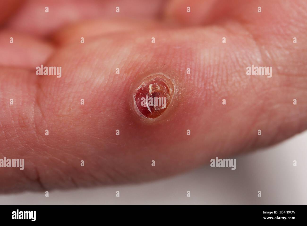 Botriomykom des Mittelfingers bei einem 26-jährigen Mann. Stockfoto