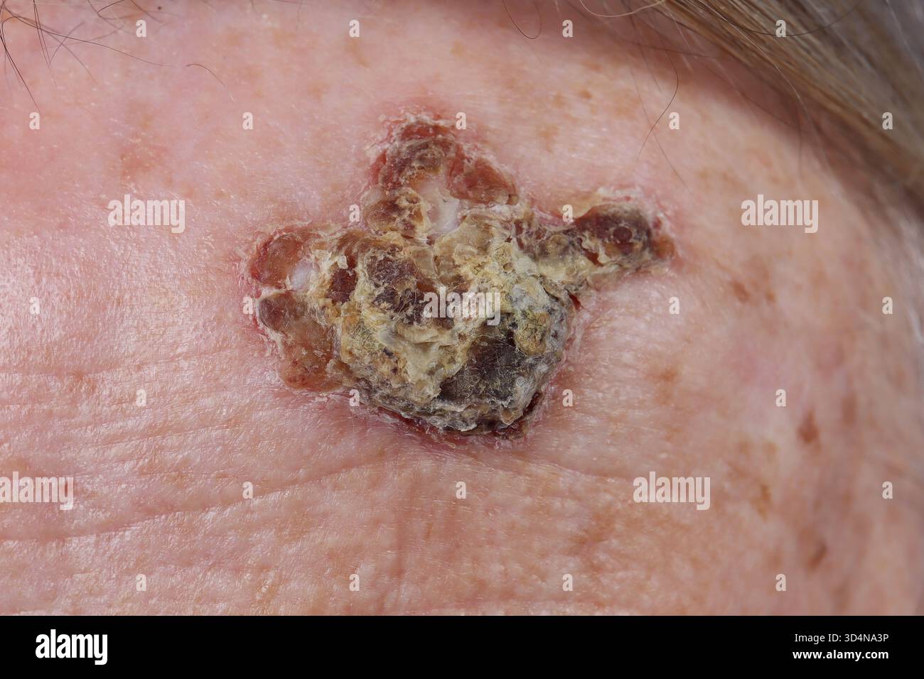 Ulzeriertes noduläres Basalzellkarzinom der Stirn bei einer 84-jährigen Frau. Stockfoto