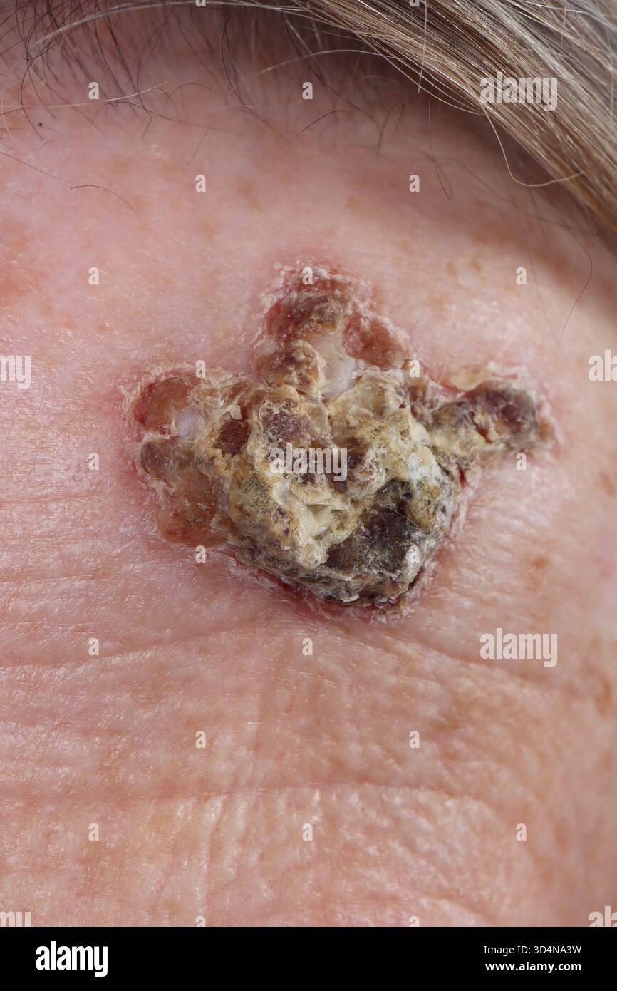 Ulzeriertes noduläres Basalzellkarzinom der Stirn bei einer 84-jährigen Frau. Stockfoto