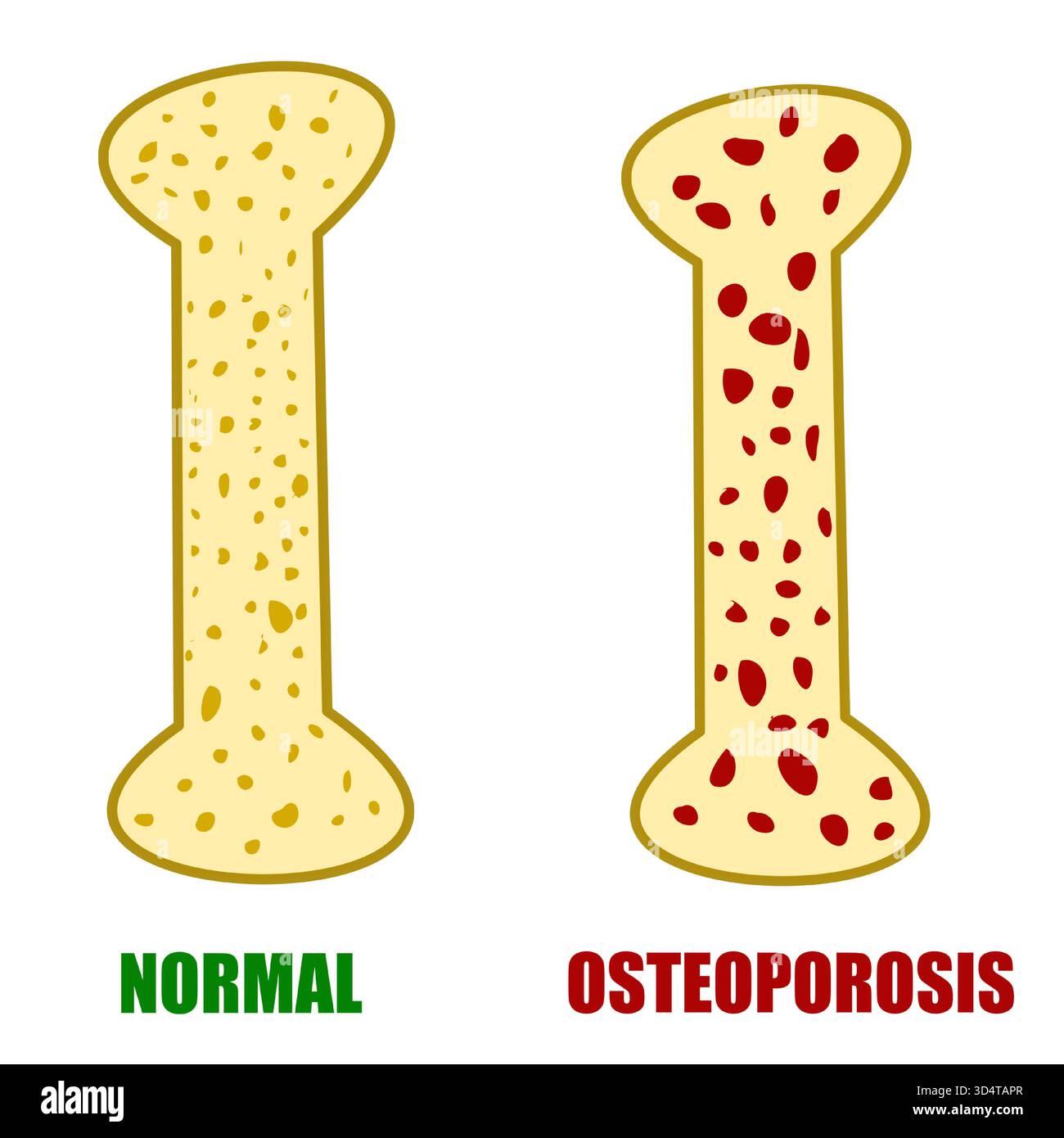 Vergleich von normalem Hea;your bone versus bone mit osteoporosemedizinischer illustraion-Krankheit Stock Vektor