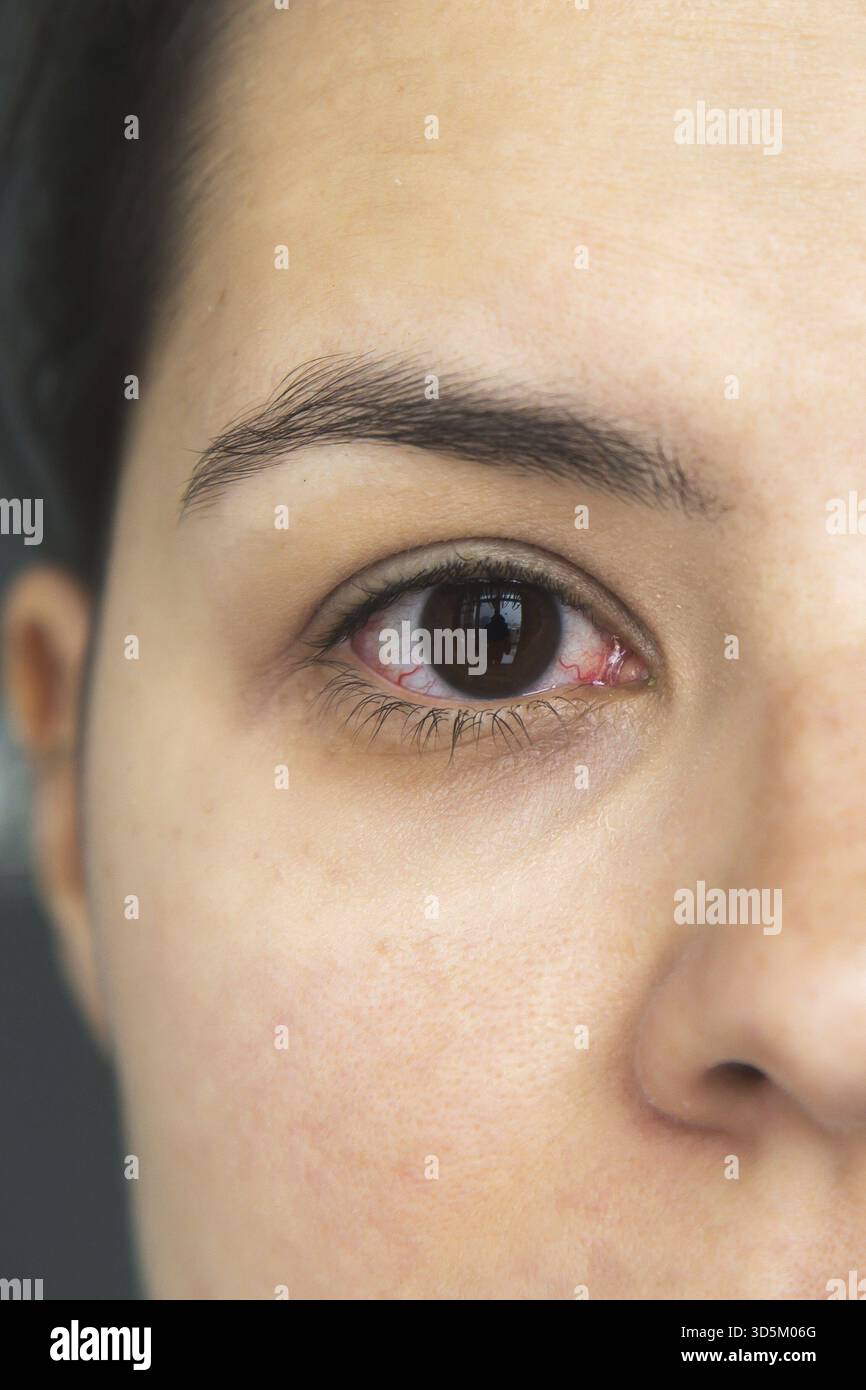 Nahaufnahme eines gereizten und roten Auges mit sichtbaren Blutgefäßen, Symptomen der Konjunktivitis oder Augeninfektion, medizinischer Zustand, Augenheilkunde, Sehvermögen Stockfoto