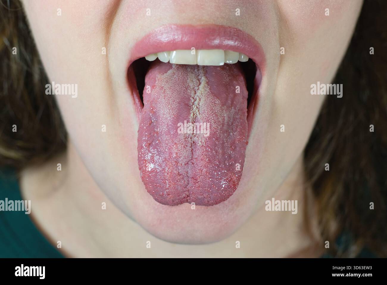 Orale Candididiasis oder oraler Trush (Candida albicans), Hefeinfektion auf der menschlichen Zunge, häufige Nebenwirkung bei der Anwendung von Antibiotika oder anderen Medikamenten Stockfoto