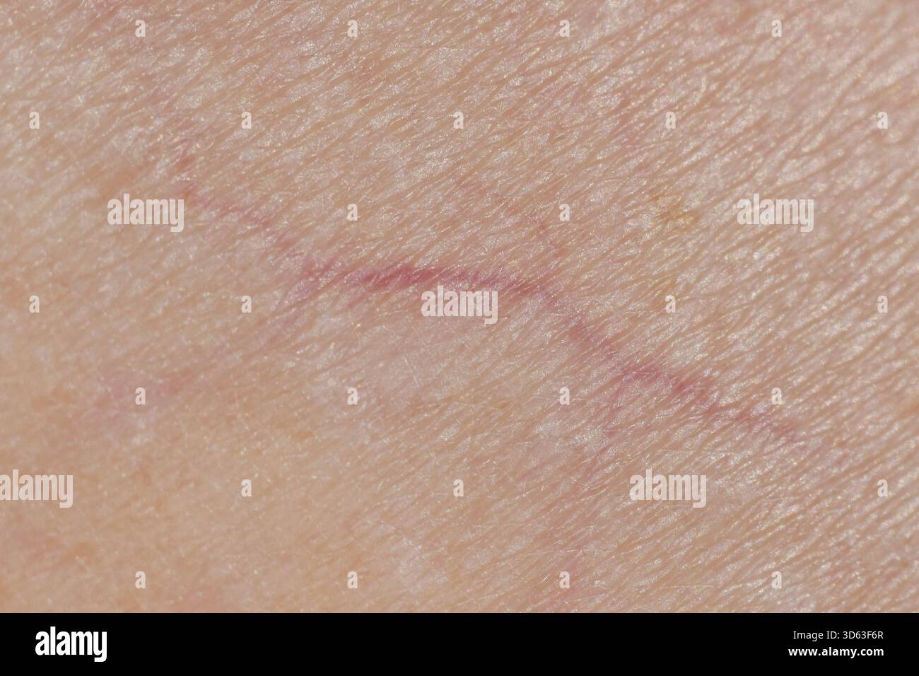 Makrofoto von Venen auf menschlicher Haut, Mikrovarizen Stockfoto