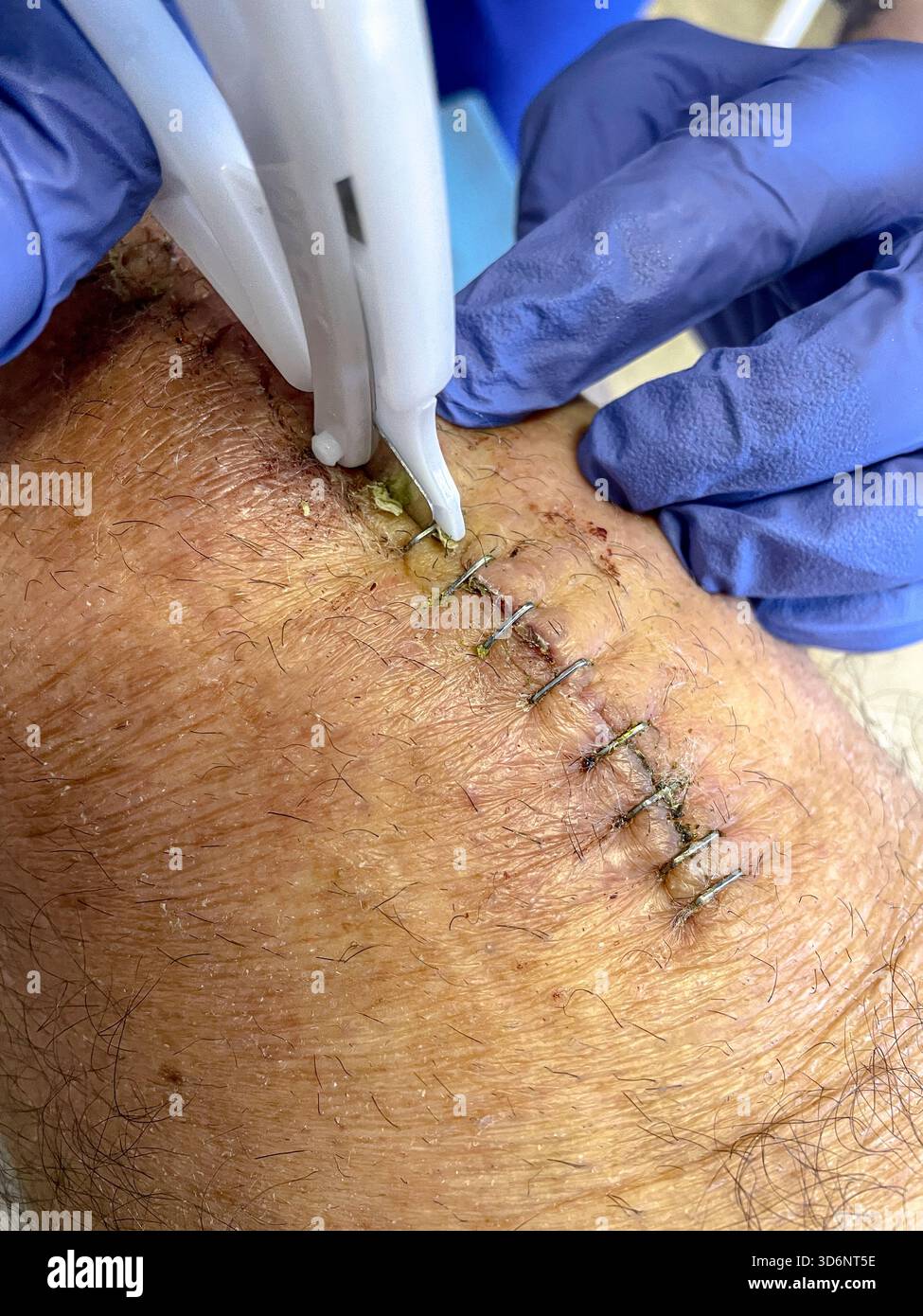 Klinische Entfernung chirurgischer Klammern aus einem heilenden Knieschnitt bei postoperativer Versorgung nach Knietotalersatz: Phillip Roberts Stockfoto