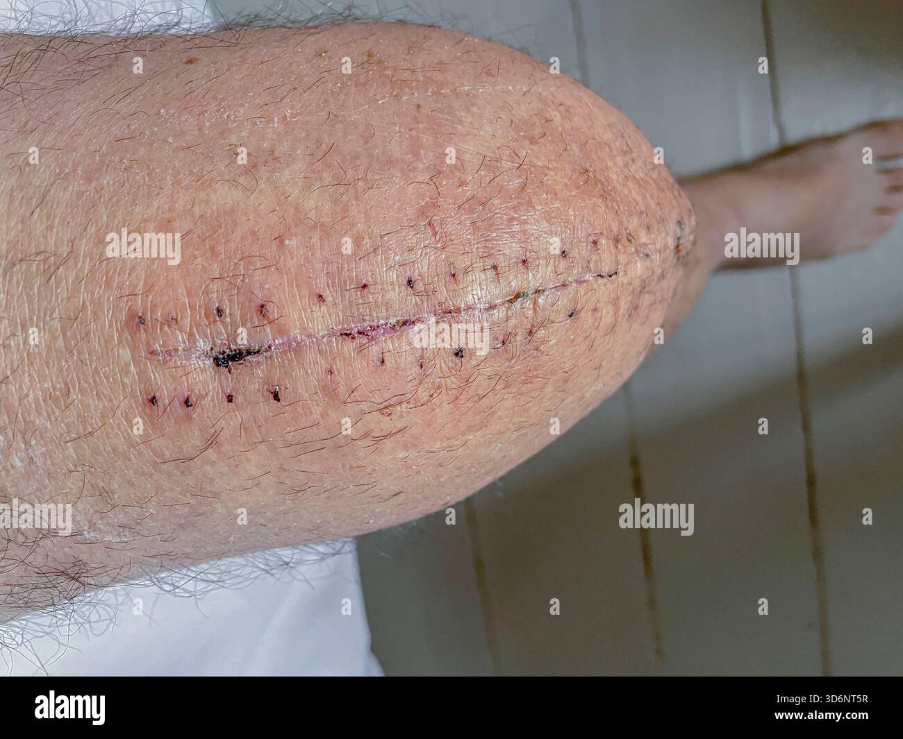 Klinische Entfernung chirurgischer Klammern aus einem heilenden Knieschnitt bei postoperativer Versorgung nach Knietotalersatz: Phillip Roberts Stockfoto