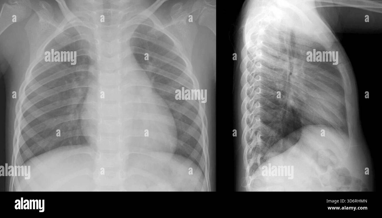 Röntgenbilder normaler Brust und Lunge bei einem Kind. Stockfoto