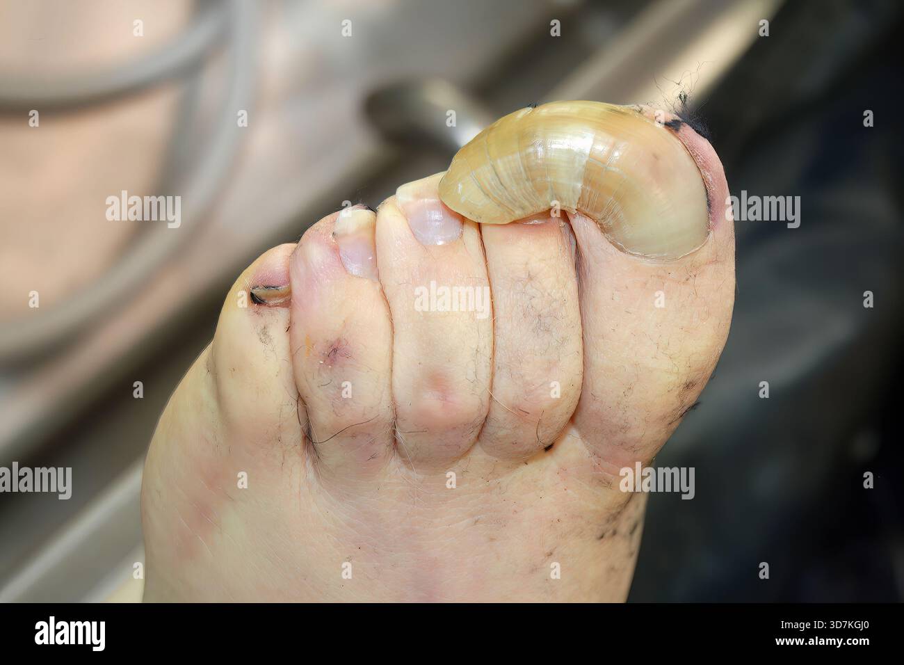 Schwere Onychogryphose Klaue Zehennagel Fuß Forensische Medizinische Pathologie Stockfoto