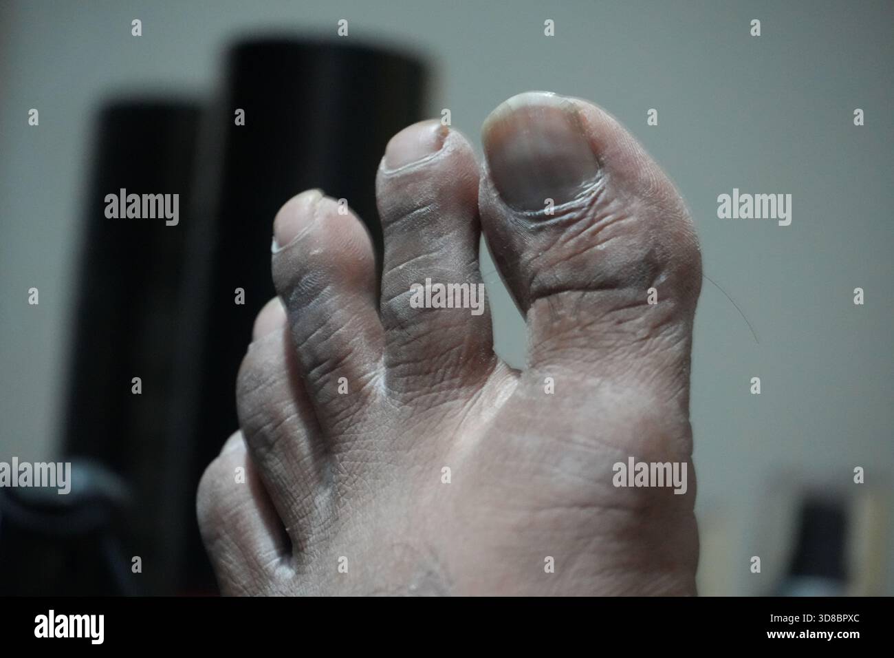 Trockene Haut an den Zehen benötigt feuchtigkeitsspendenden Balsam für beruhigende Linderung und weiche gesunde Haut, sichtbare Trockenheit Detail Stockfoto