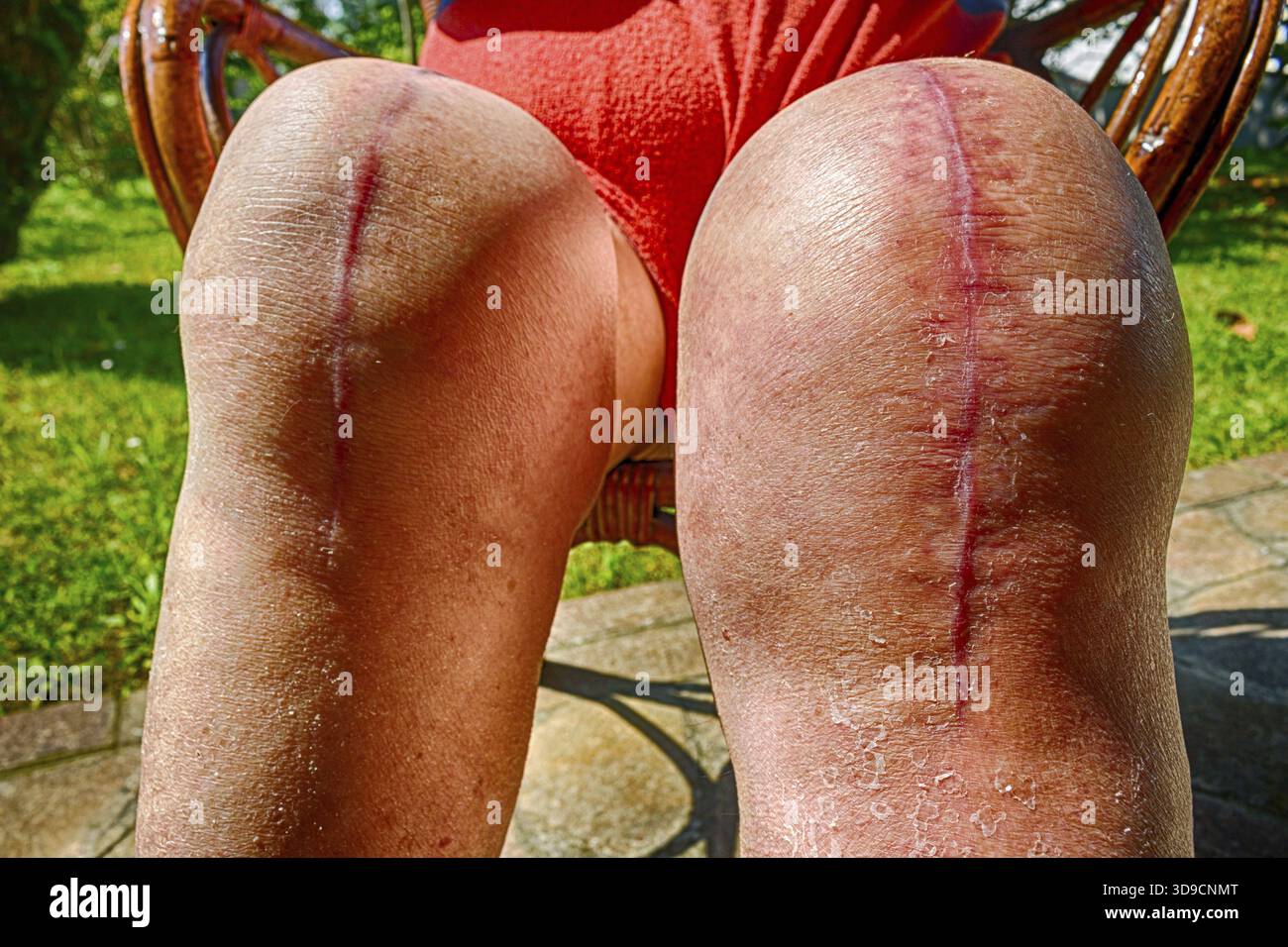 Narben an alten Beinen, die sich einer Kniegelenkersatzoperation unterzogen haben Stockfoto