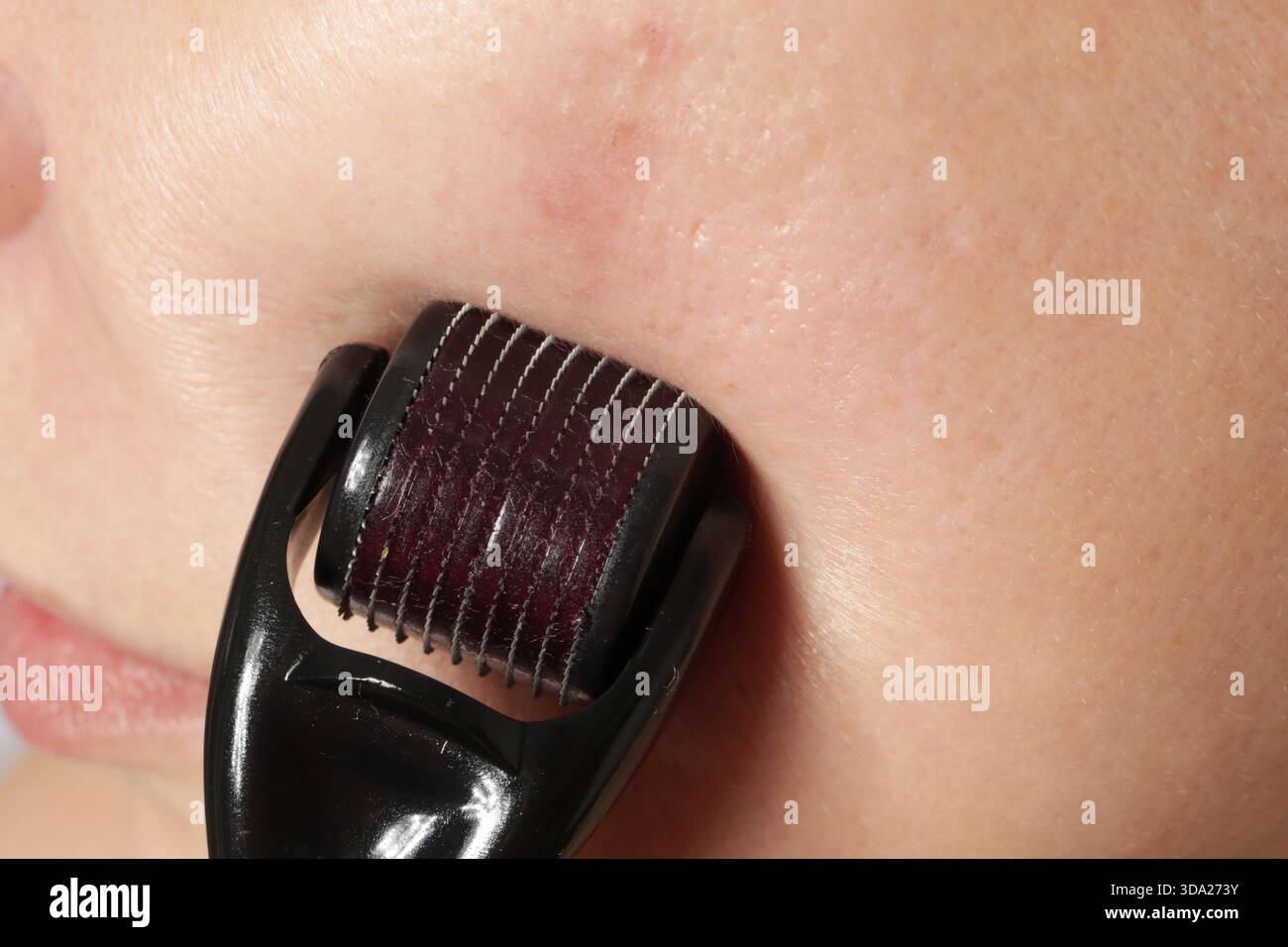 Gesichtsmassage mit Mikronadeldermaroller zur Behandlung von Narben, Falten und zur Gesichtsverjüngung. Einfache und günstige Hautpflege zu Hause Stockfoto