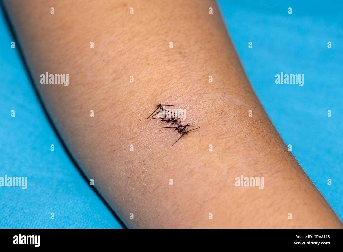 Schwarze Operationsnähte vor ihrer Entfernung aus der Wunde. Nahaufnahme der Wundheilung nach Schulteroperationen. Stockfoto