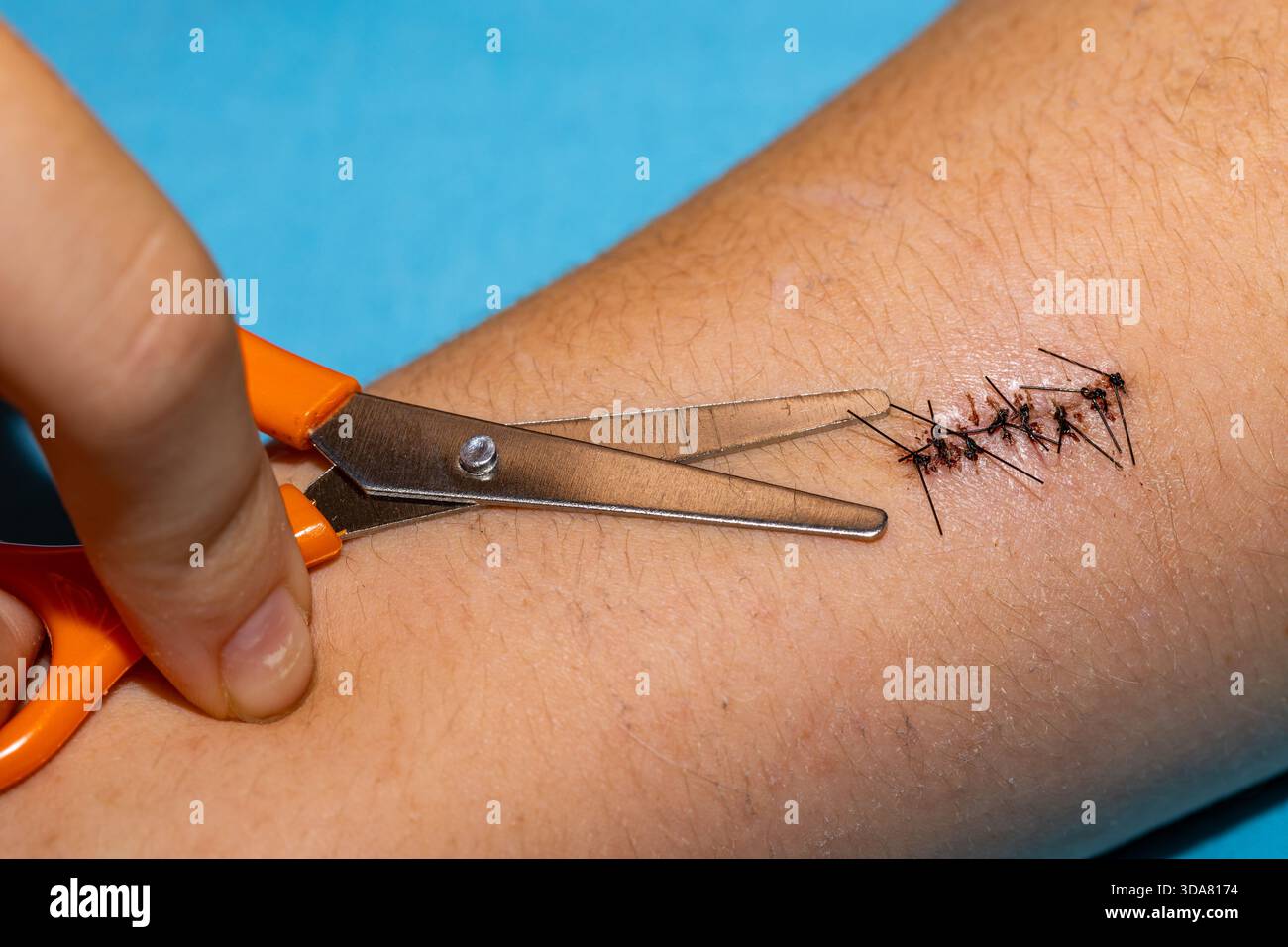 Schwarze Operationsnähte vor ihrer Entfernung aus der Wunde. Nahaufnahme der Wundheilung nach Schulteroperationen. Stockfoto