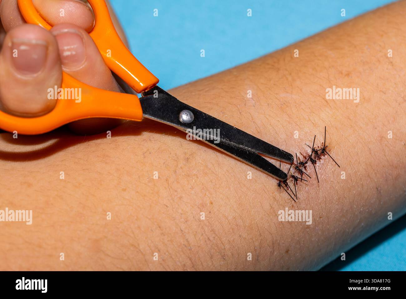 Schwarze Operationsnähte vor ihrer Entfernung aus der Wunde. Nahaufnahme der Wundheilung nach Schulteroperationen. Stockfoto