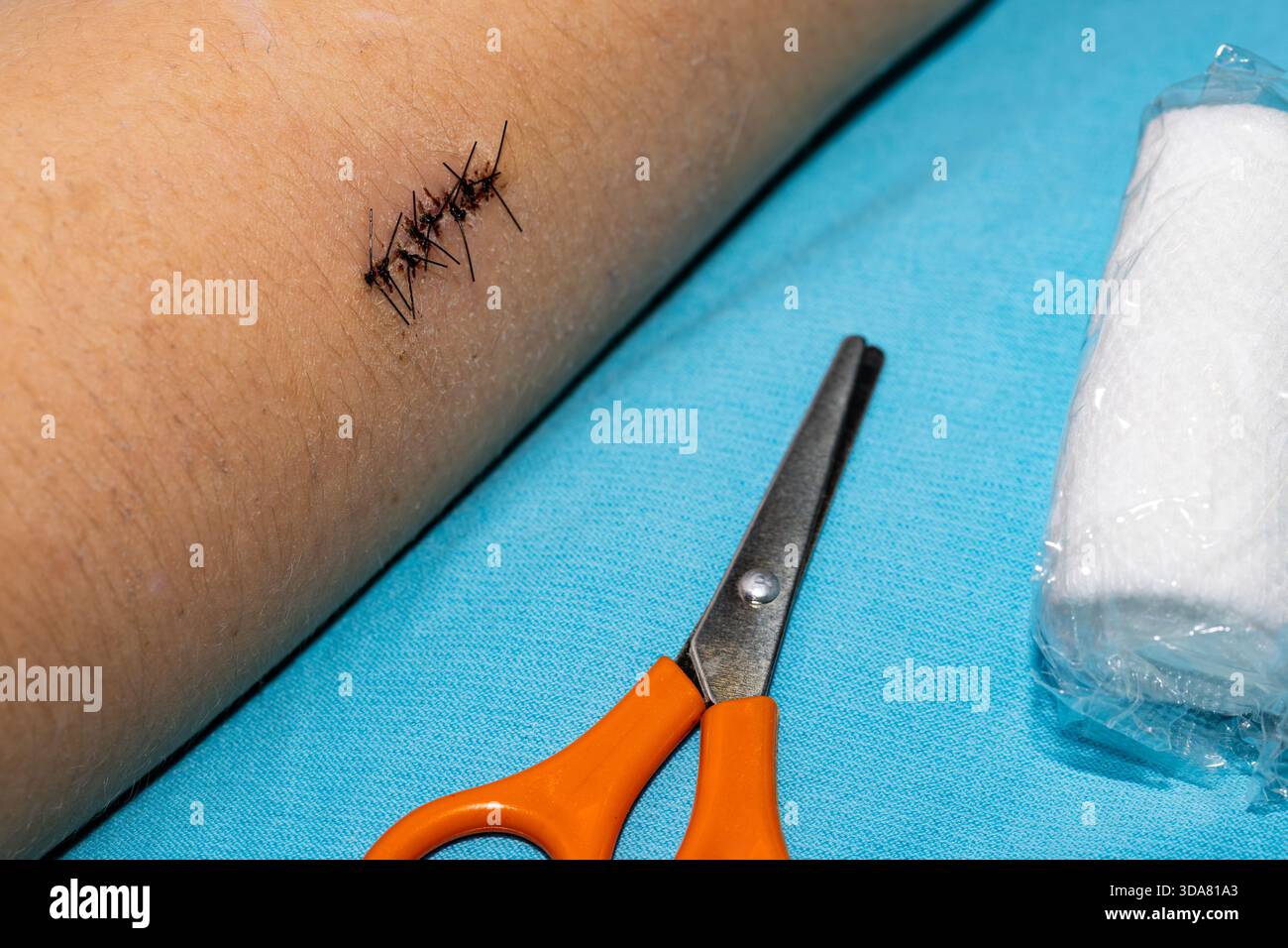 Schwarze Operationsnähte vor ihrer Entfernung aus der Wunde. Nahaufnahme der Wundheilung nach Schulteroperationen. Stockfoto