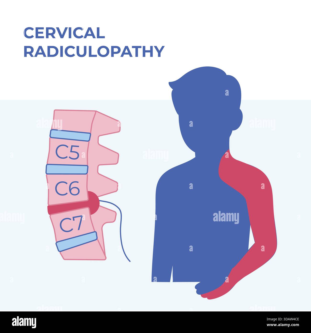 Vektormedizinische Illustration der zervikalen Radikulopathie mit Bandscheibenvorfall und entsprechenden Schmerzbereichen in Hals, Schulter und Oberschenkel. Stockfoto