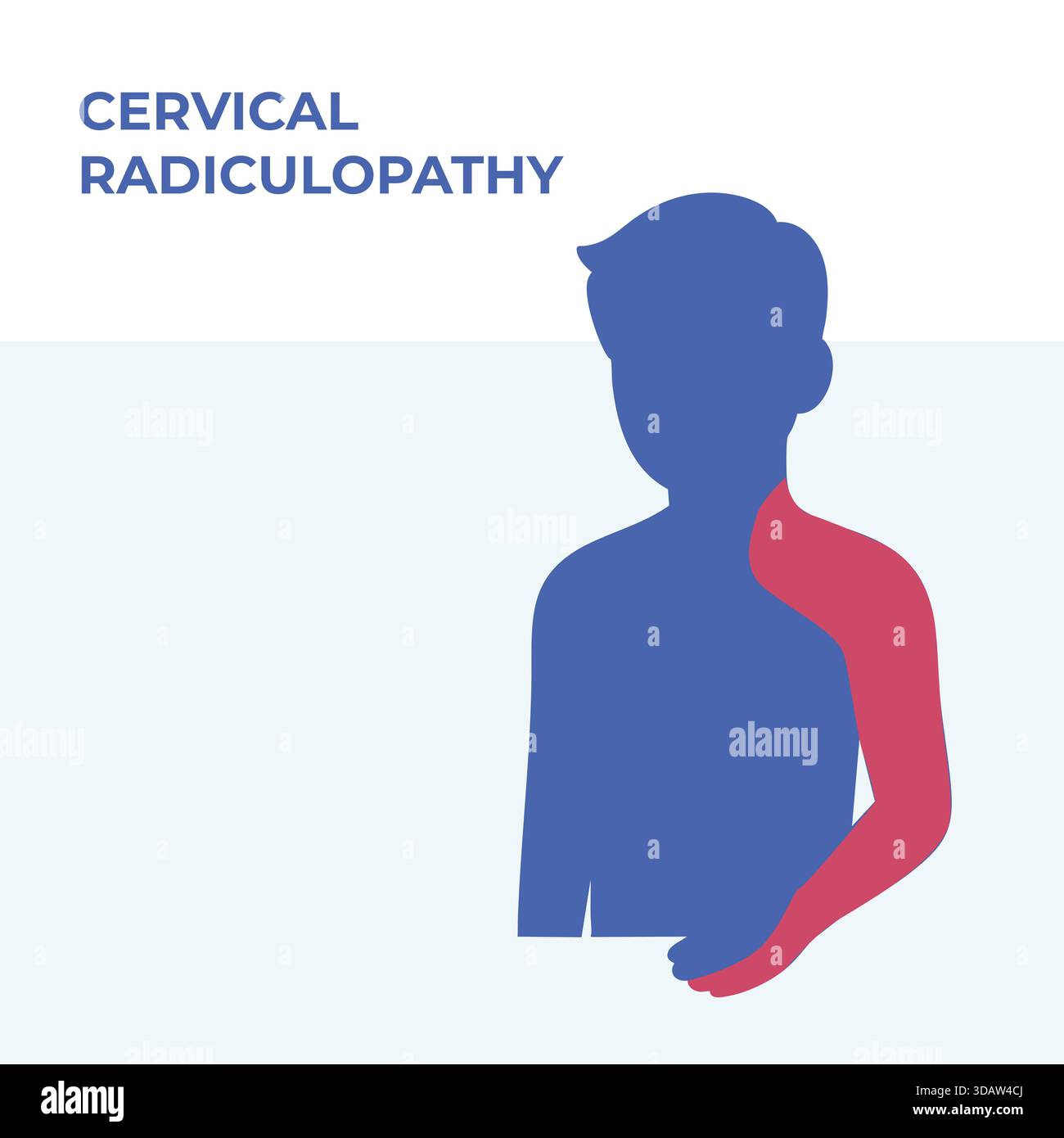 Vektor-Illustration, die Schmerzverteilungsbereiche zeigt, die mit zervikaler Radikulopathie assoziiert sind, wobei Nacken-, Schulter- und Armregionen hervorgehoben werden. Vereinfacht Stockfoto
