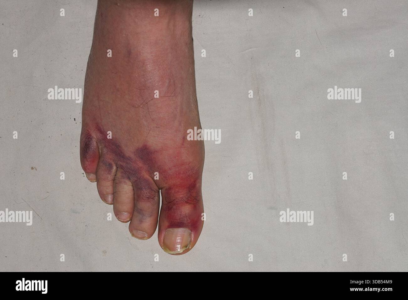 Verletzt und geprellter Zeh am rechten Fuß eines Mannes Stockfoto