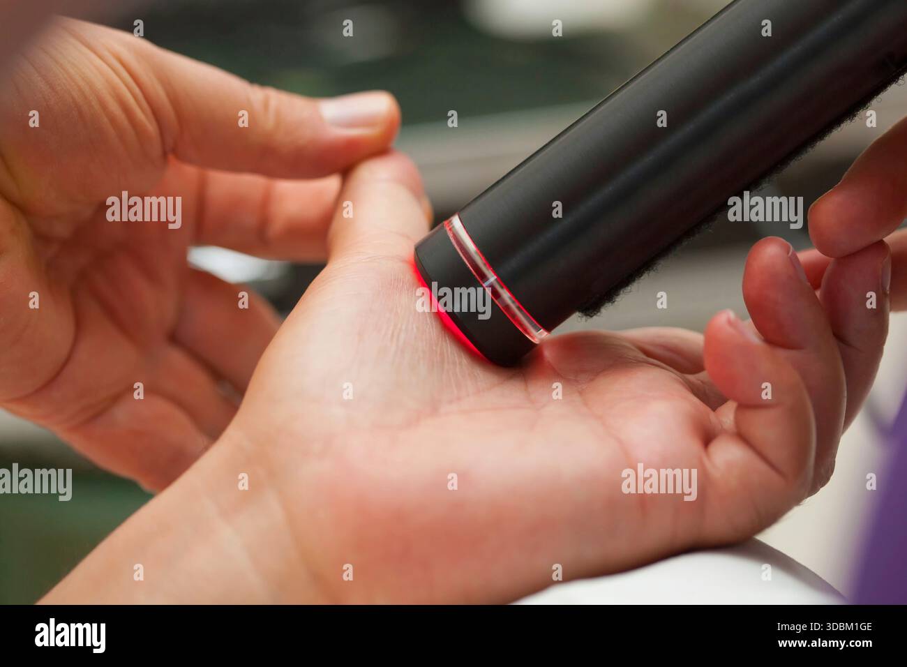 Behandlung-Laser-Therapie der Artikulation des Daumens. Stockfoto