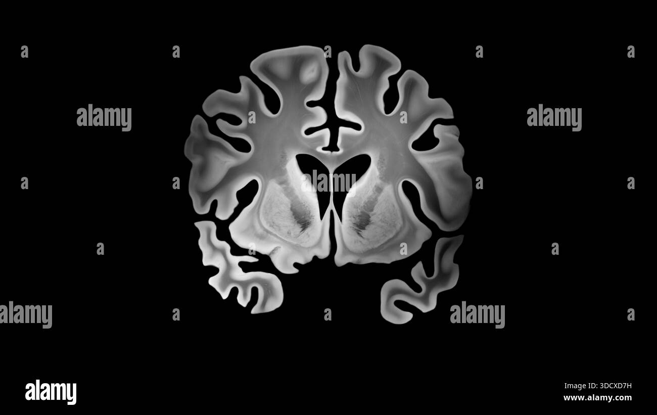 Alzheimer bilaterale koronale Hirnschicht mit kortikaler Ausdünnung verbreiterter Sulci vergrößerte Ventrikel und mediale Temporallappenatrophie, die beide hemis betrifft Stockfoto