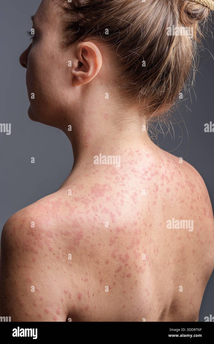 Eine Frau mit einem roten, fleckigen Hautausschlag, verursacht durch Masern. Stockfoto