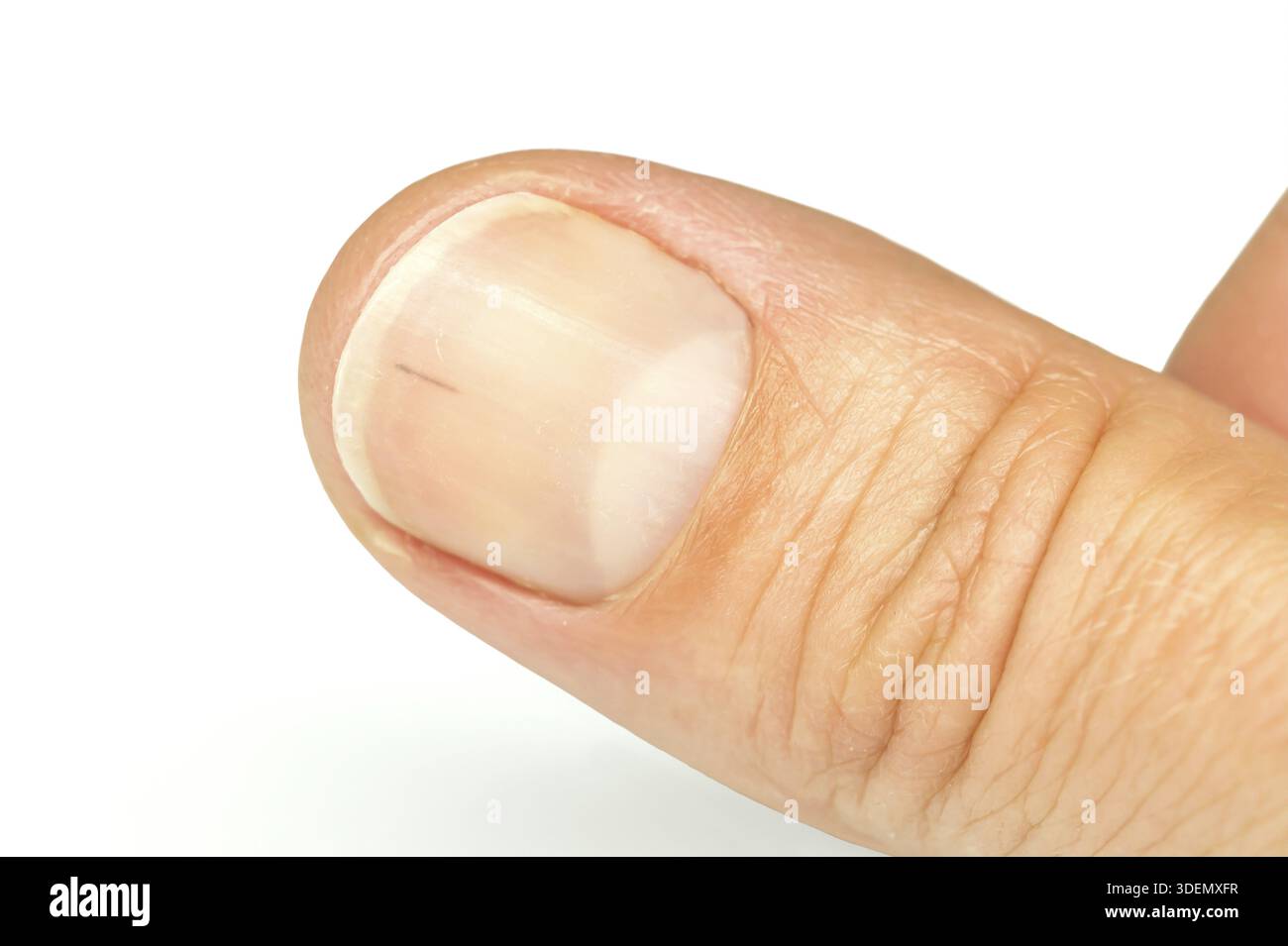 Daumen-Fingernagel mit Splitter. Splitter unter dem Nagel Nahaufnahme.  Makrobild Stockfotografie - Alamy