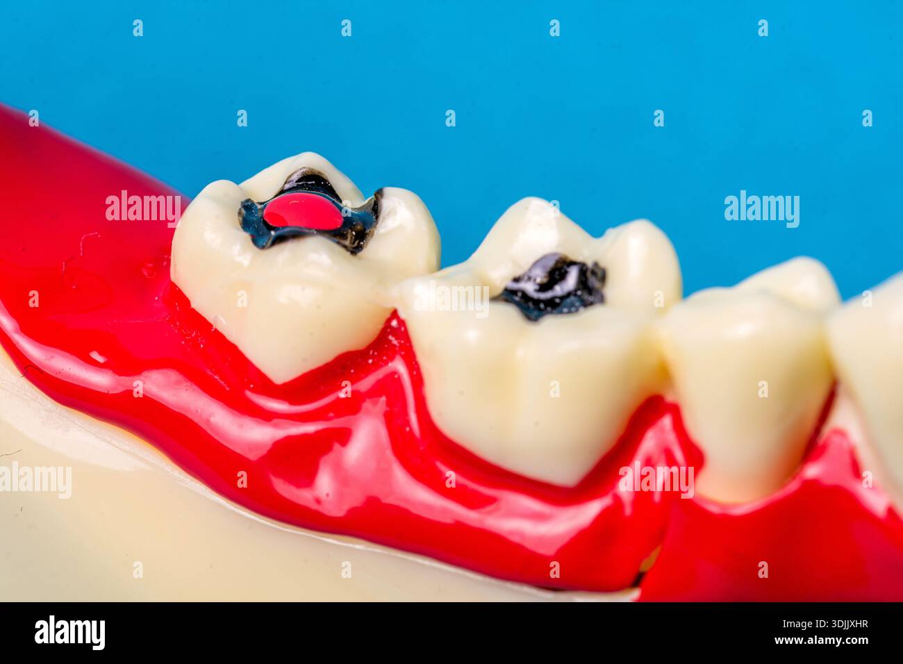 Dentalmodell mit Karies, Zerfall und Füllungen Stockfoto