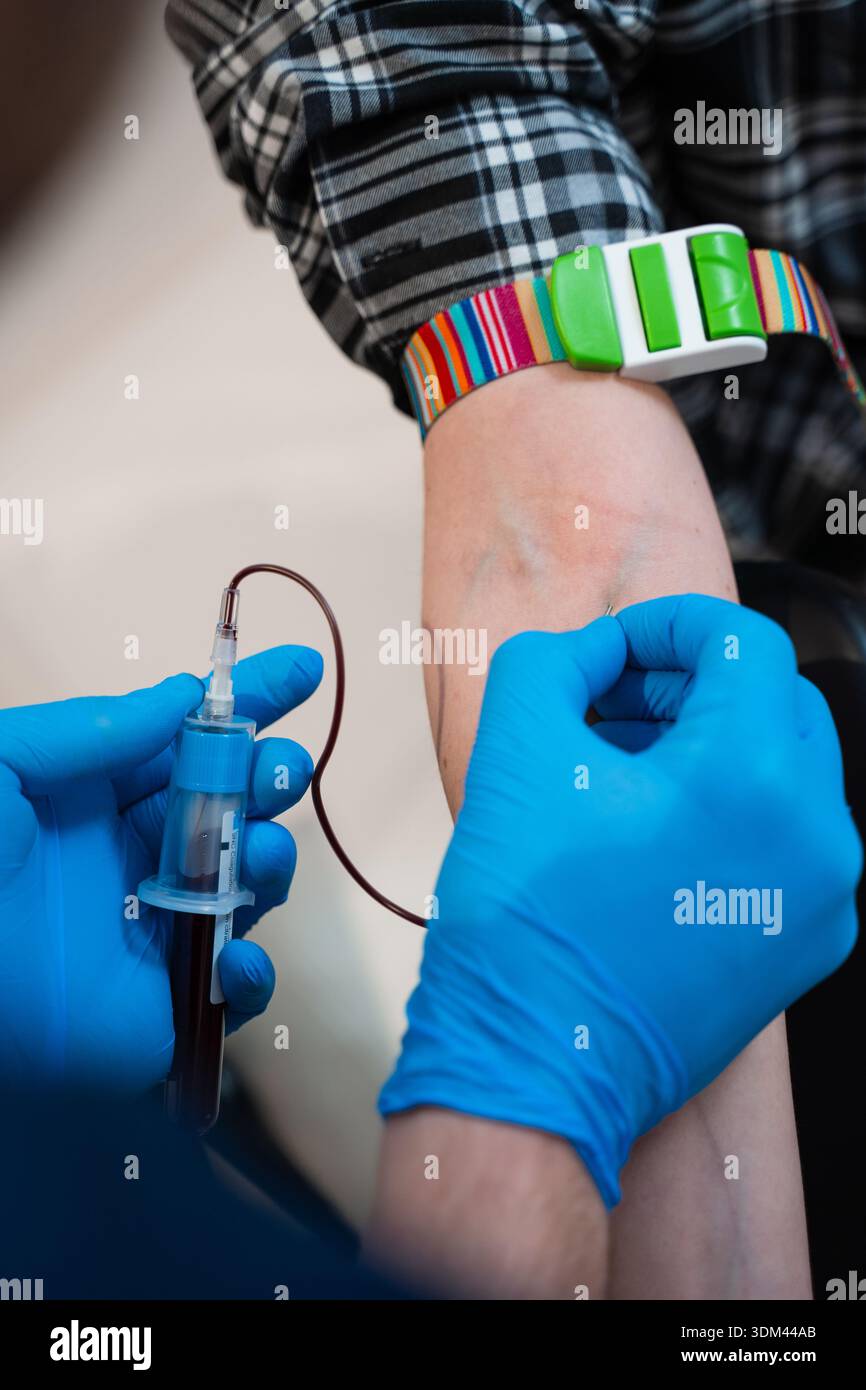 Venöses Blut, das vom Facharzt zur PRP-Präparation vor der Kopfhautmesotherapie entnommen wird Stockfoto