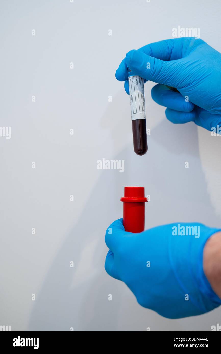 Venöses Blut im Reagenzglas, das vor dem Zentrifugieren für die PRP-Behandlung vorbereitet wurde Stockfoto