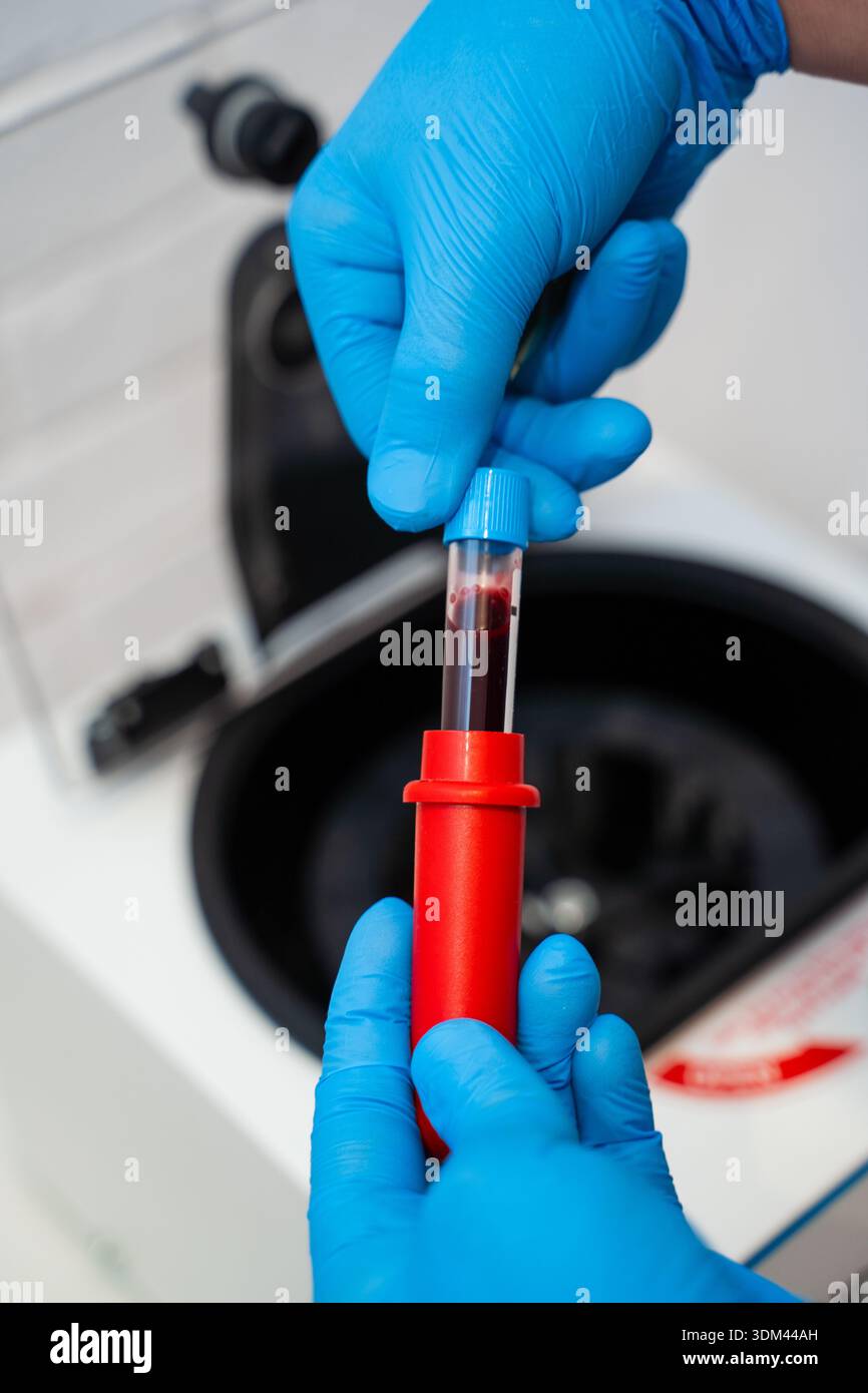 Teströhrchen mit venösem Blut, bereit für die PRP-Vorbereitung vor dem Zentrifugieren Stockfoto