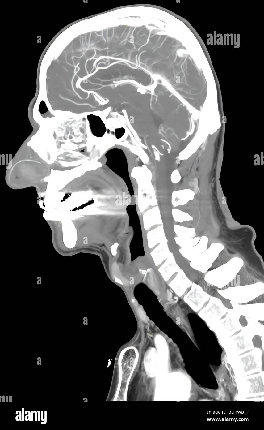 Menschlicher Kopf-CT-Scan mit Hirn- und Gefässsystem eines 72-jährigen gesunden männlichen Patienten Stockfoto