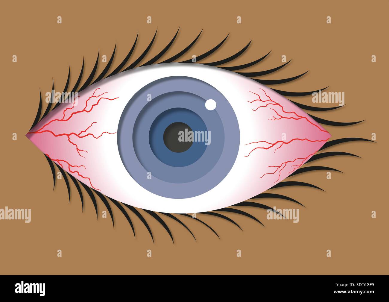 Illustration der Konjunktivitis. Allgemein als rosafarbenes Auge bezeichnet, bei einer Entzündung der klaren Membran, die den weißen Teil des Auges bedeckt. Sie kann durch virale oder bakterielle Infektionen, Allergien oder Reizmittel verursacht werden. Symptome sind rote, juckende und brennende Augen, oft begleitet von übermäßigem Tränen und klebrigem Ausfluss. Das Rosa Auge verschwindet normalerweise innerhalb von ein bis zwei Wochen. Die Behandlung konzentriert sich auf Methoden wie Kältekompressionen, künstliche Tränen und bei bakteriellen Infektionen Antibiotika. Stockfoto