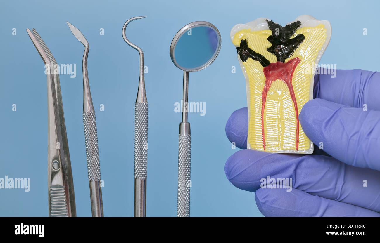 Zahnärztliches Ausbildungskonzept mit einem Zahnquerschnittsmodell mit sichtbarer Karies und innerer Anatomie Stockfoto